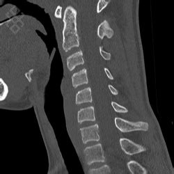 Scanner Du Rachis Cervical D Finition D Roulement Prise De Rdv