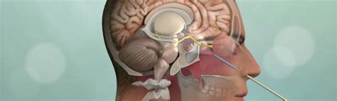 Minimally Invasive Brain Surgery Keyhole Craniotomy Pacific Brain Tumor Center