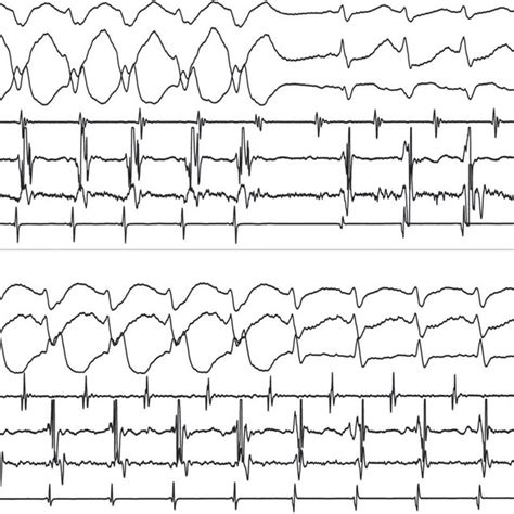 Twelve Lead Surface Ecg During Wide Qrs Complex Tachycardia A Wide