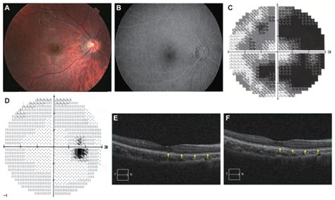 Fundus Photograph Fluorescein Angiographic Image Humphrey Static