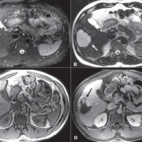 Met Stase De Neoplasia De C Lon A Tc Fase Portal B Rm Fse T