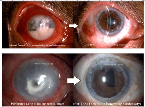 Pk Penetrating Keratoplasty Cornea