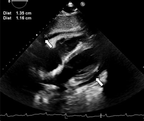 An Apical Four Chamber View On Transthoracic Echocardiogram Obtained On