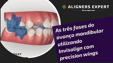 As três fases do avanço mandibular utilizando Invisalign precision