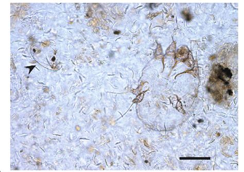 Photomicrograh Of A Sarcoptes Scabiei Mite And An Egg Arrow In Skin