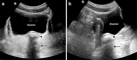 Vaginal Foreign Body In A 10 Year Old Girl Who Reported Placing A Rock