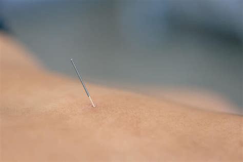 Understanding The Basics Of Dry Needling What You Need To Know