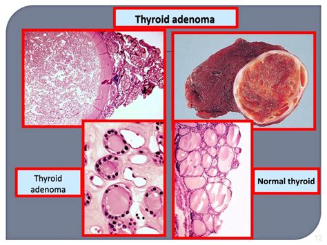 Ppt Neoplasia Powerpoint Presentation Free Download Id 6161338