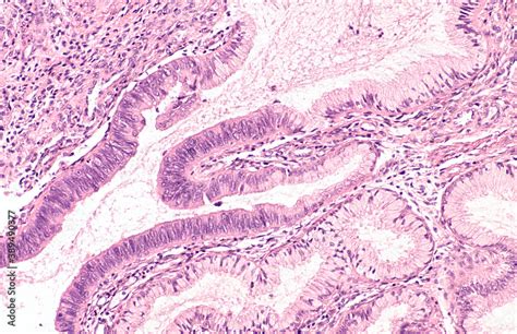 Cancer Of Cervix Cervical Biopsy From A Woman With An Abnormal Pap