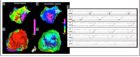 Complete Elimination Of The Late Potentials By Endo Epicardial Catheter