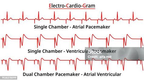 Set Of Ecg Common Abnormalities Single Vs Dual Chamber Pacemaker Atrial