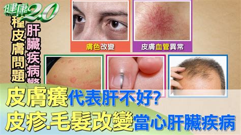 皮膚癢代表肝不好？ 皮疹、毛髮改變當心肝臟疾病 健康20 Youtube