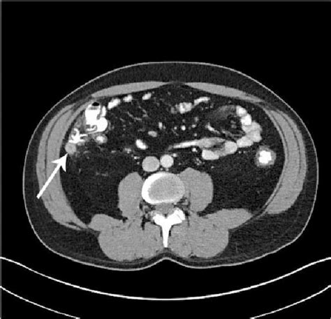 Axial Computed Tomography Scan With Contrast Of The Abdomen