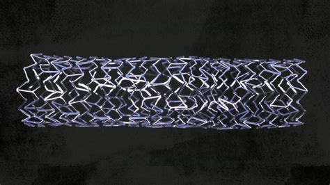 Stent placement: Types, procedures, risks, recovery