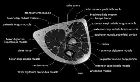 Mri Anatomy Of Elbow Axial Cross Sectional Anatomy Of Elbow Joint