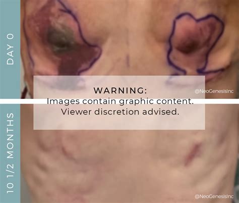 Double Mastectomy Necrosis Before And After Care Neogenesis