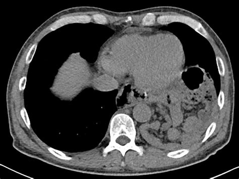 Symptomatic Huge Diaphragmatic Hernia Bmj Case Reports