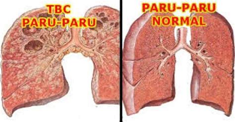 Penyakit Paru Paru Yang Disebabkan Oleh Mycobacterium Tuberculosis