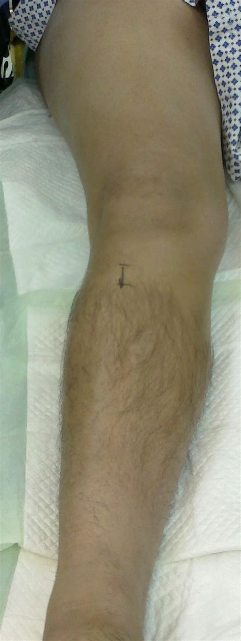 Limb Lengthening And Reconstruction Dr Mohamed Attia M D PhD