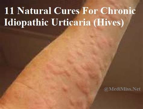 Pin By GeGe Noyce On Natural Treatment For Hives Chronic Idiopathic