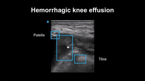 Knee Effusion Ultrasound