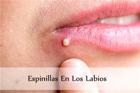 Granos De Fordyce O Herpes Labio Gato Inchado