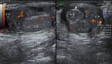 Testicular Appendage Torsion Ultrasound