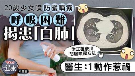 防曬護理｜20歲少女噴防曬噴霧呼吸困難揭患「白肺」 醫生：1動作惹禍