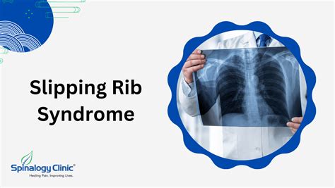 Understanding Slipping Rib Syndrome: Causes, Symptoms, and Treatment ...