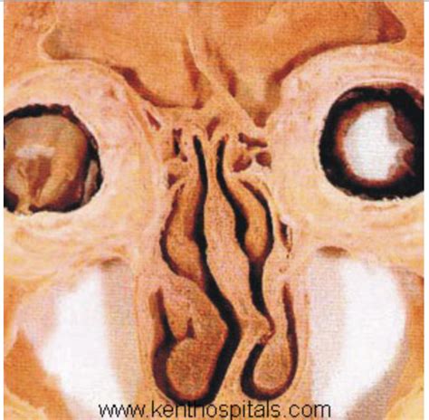 Coronal Section Of Sinuses Diagram Quizlet