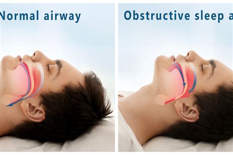 Obstructive Sleep Apnea Diagnosis Code Icd 10