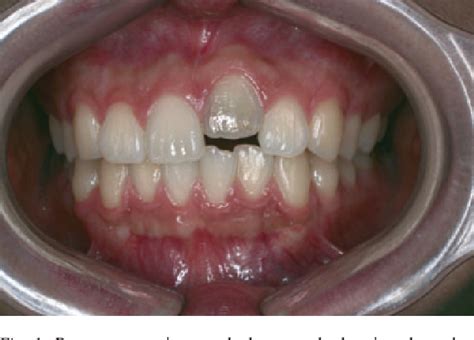 Figure 1 From Miniscrew Anchored Alveolar Distraction For The Treatment Of The Ankylosed