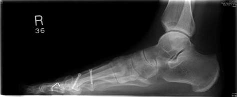 Scarf Osteotomy Preoperatively A And At Months B And C