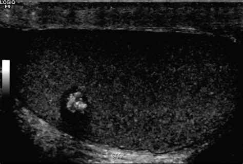 Epididymal Cyst Ultrasound