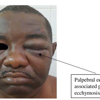 Palpebral edema associated with a left periorbital ecchymosis ...