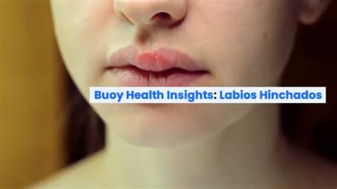 Labios Hinchados Causas Comunes Y Cuándo Buscar Atención Médica Youtube