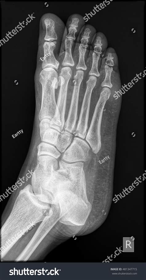 Xray Human Right Foot Sidelateral View Stock Photo 481347715 | Shutterstock