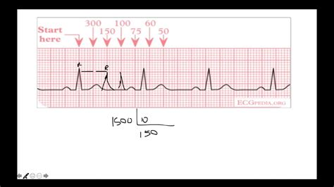 Calcular La Frecuencia CardÍaca En El Electrocardiograma Ekg MÉtodo De Los 1500 300 Y MÁs