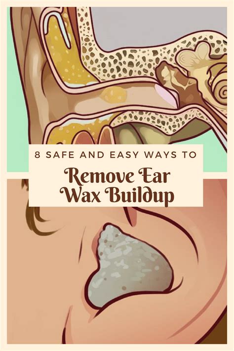 How To Remove Soft Sticky Ear Wax At Vicki Carbone Blog