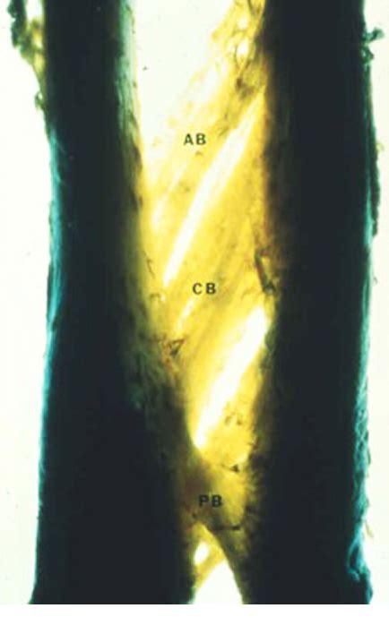 Figure From Interosseous Membrane Reconstruction For The Essex