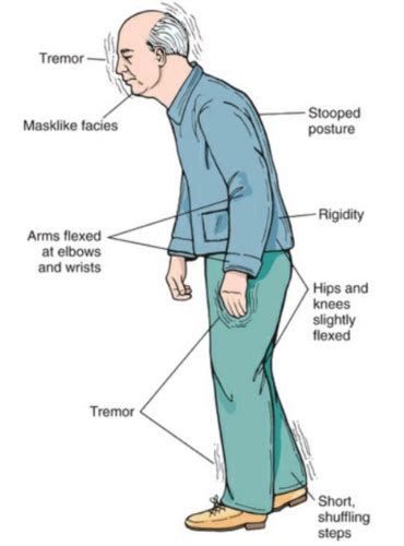 Parkinson S Disease Flashcards Quizlet