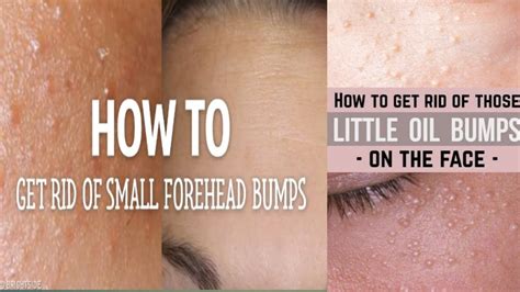 How To Get Rid Of Small Tiny Bumps On Forehead Face Simple Easy