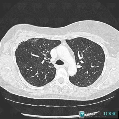 Radiology case : Radiation pneumonitis (CT) - Diagnologic