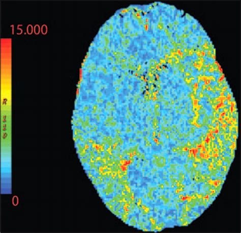 Imaging Of Stroke Part Perfusion Ct Overview Of Imaging Technique