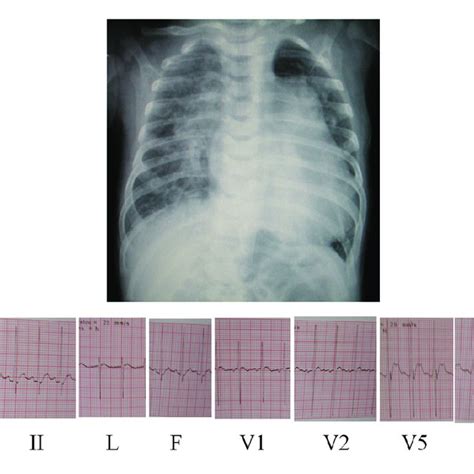 Chest X Ray Showing The Enlarged Cardiac Silhouette And Pulmonary