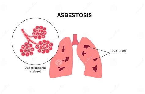 Asbestosis Lung Disease Stock Vector Illustration Of Personal 279323856