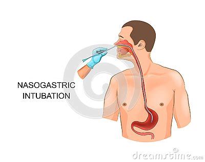 Nasogastric Tube In The Stomach Cartoon Vector Cartoondealer