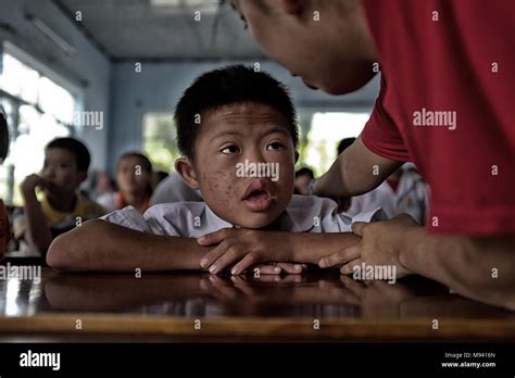 Agent Orange Victims in Vietnam Stock Photo - Alamy