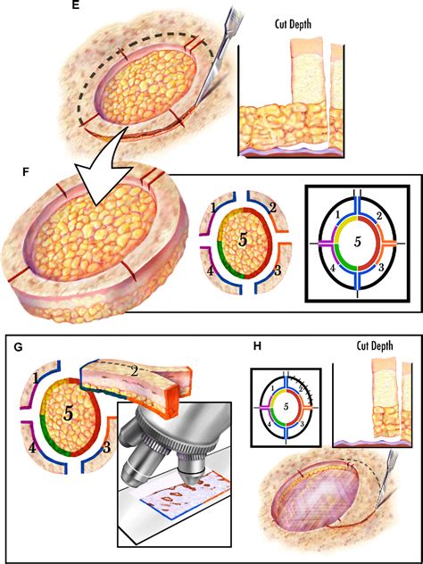 Figure 1 From Low Recurrence Rates For In Situ And Invasive Melanomas