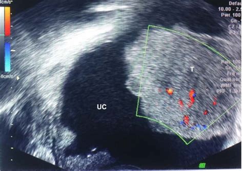 Large Prostatic Utricle With Transitional Cell Carcinoma In An Adult Urology